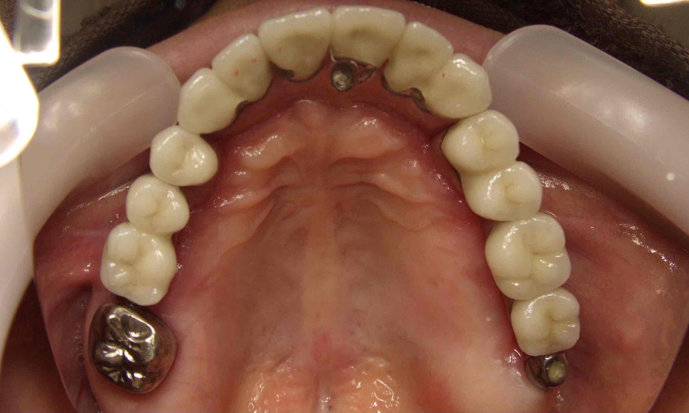 症例④上顎の即時負荷インプラント治療後の最終上部構造装着